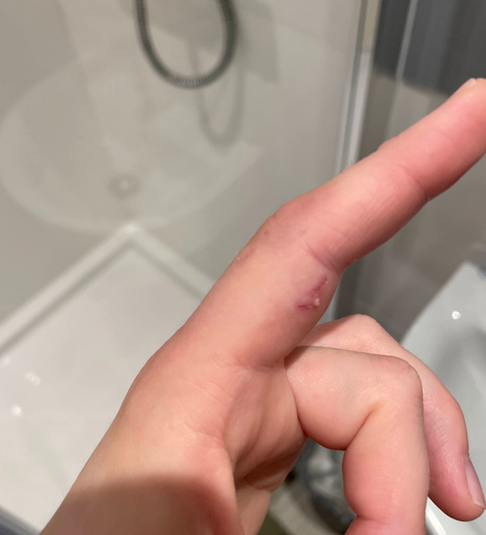 Rat bite sustained from seizure episode