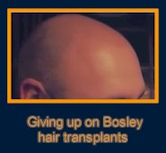 Giving up on Bosley hair transplant
