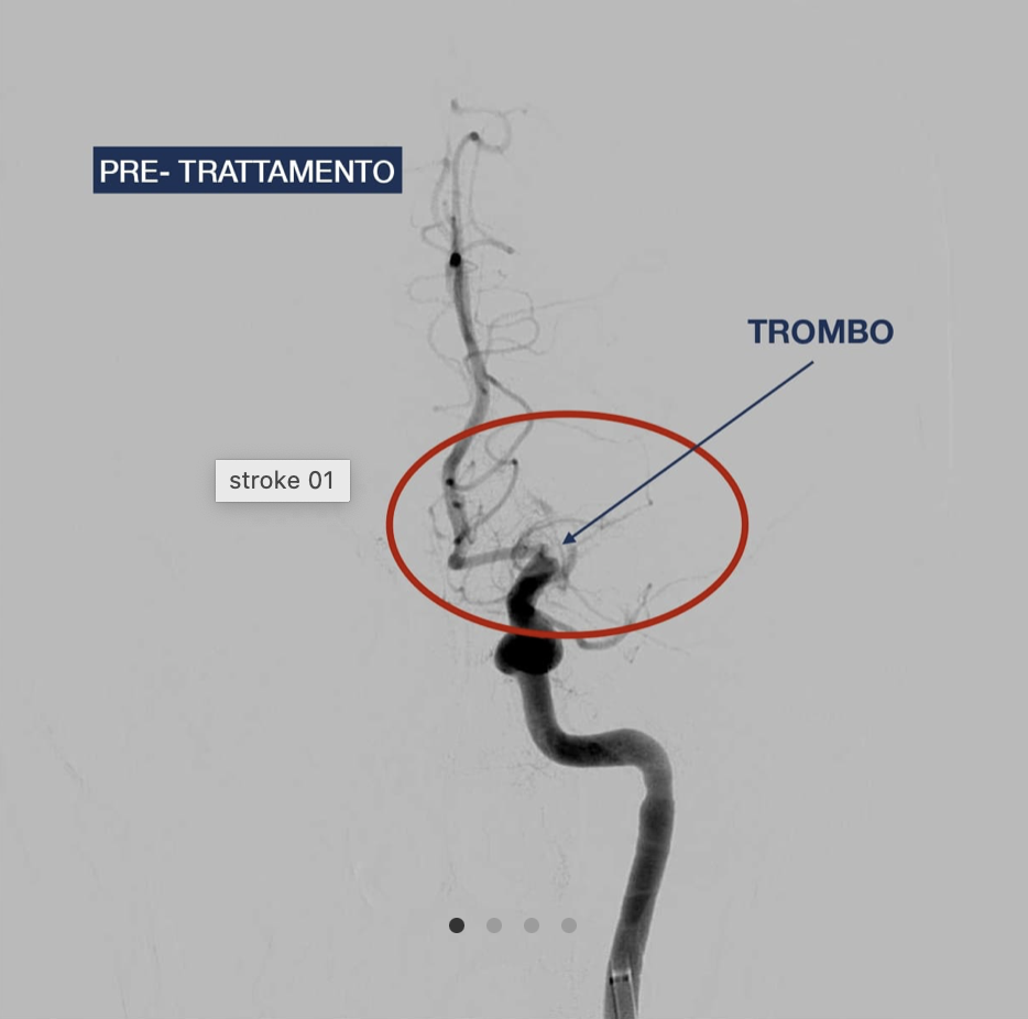 trombectomia cererbale