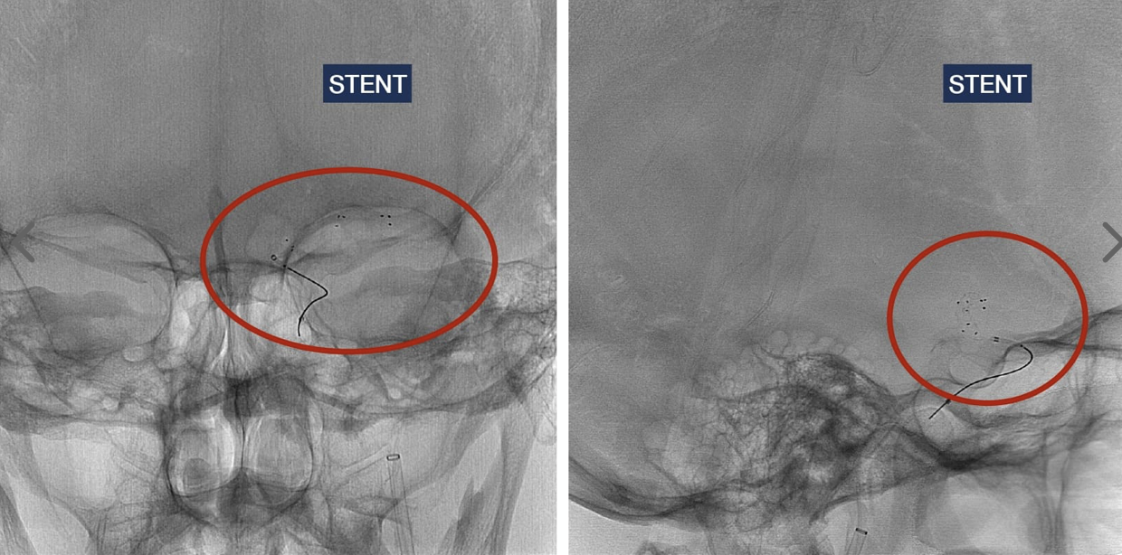 Trombectomia con stent