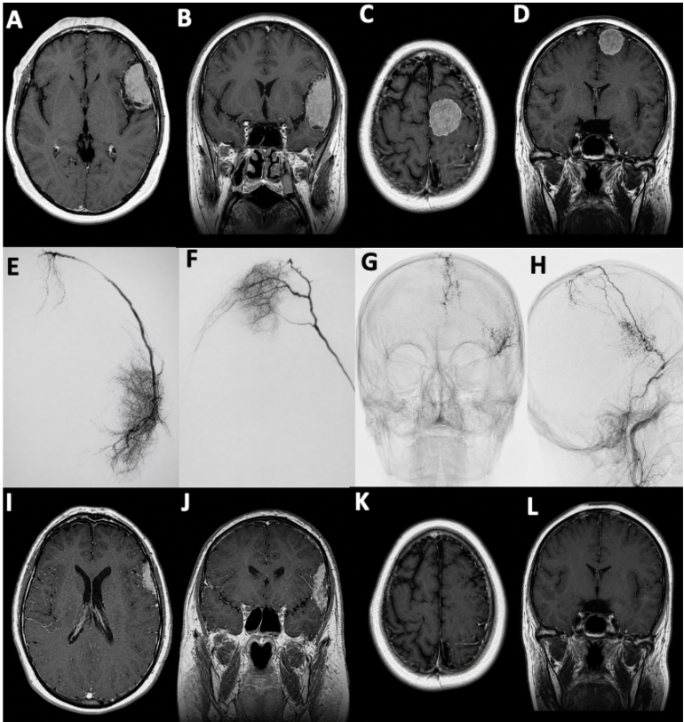Embolizzazione endovascolare del meningioma