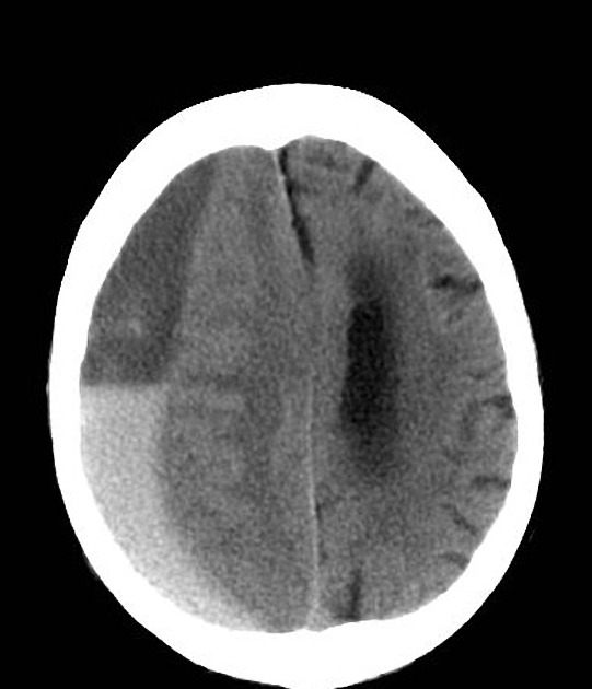 ematoma sottodurale cronico