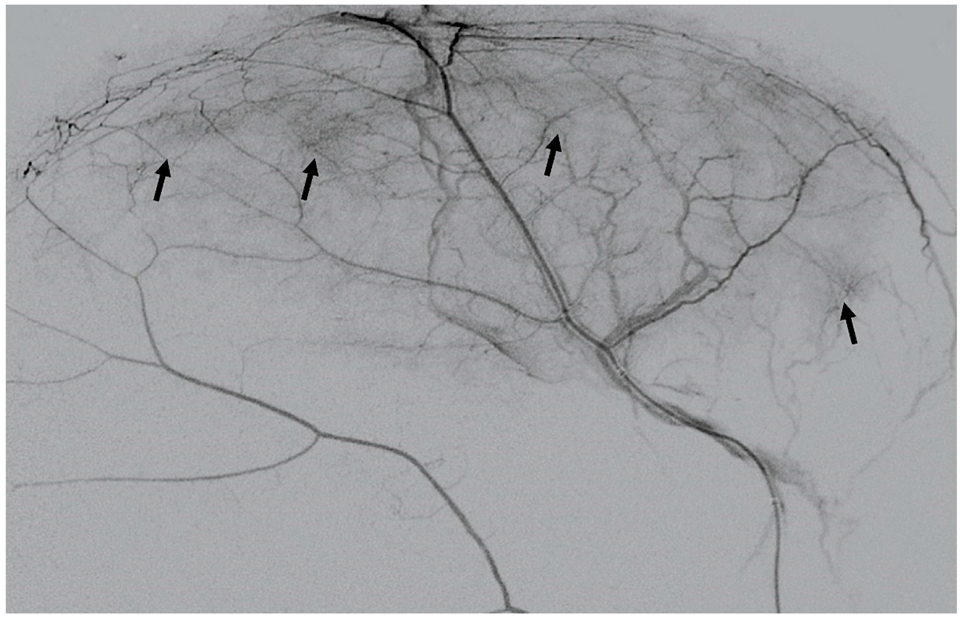 embolizzazione ematoma sottodurale cronico