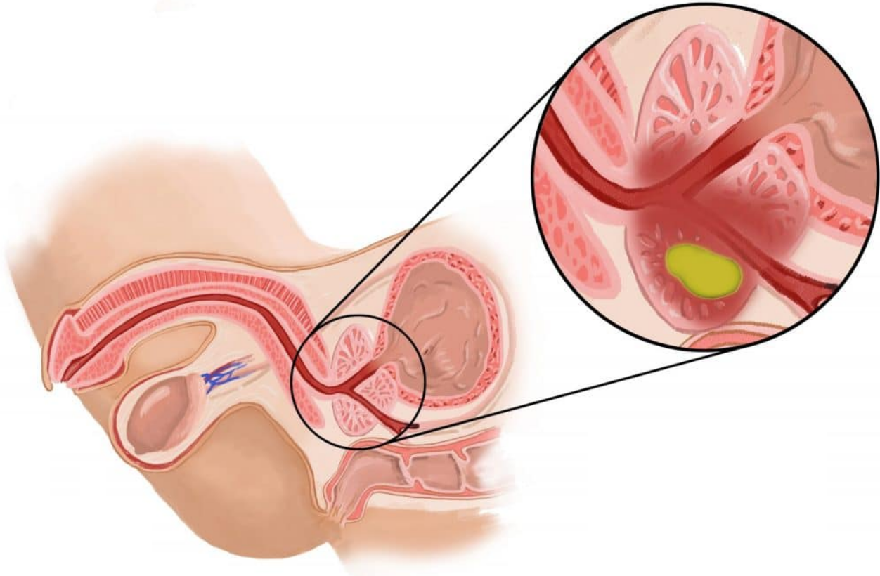 Prostatitis Profizikal Beograd