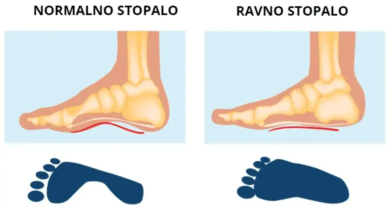 Ravna stopala Profizikal Beograd