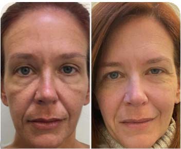 Before/After