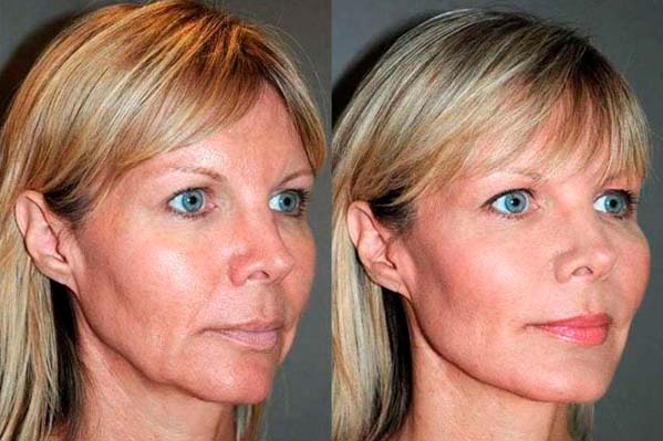 Before/After