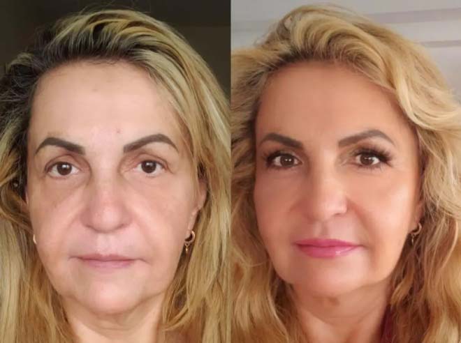 Before/After