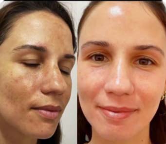 Before/After