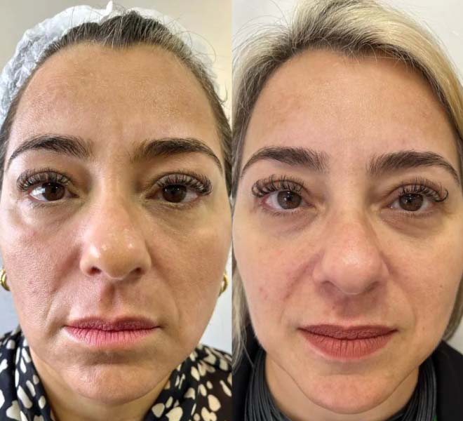 Before/After
