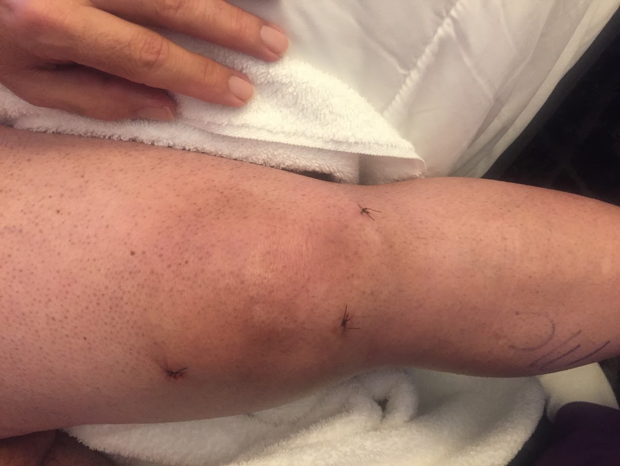 Tom had to have surgery on his knee while still at hotel