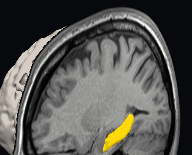 実際の解析画面。黄色部分がAIの判定した海馬
