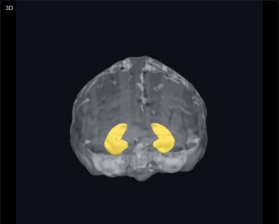 MyBrainの3Dビューワー画面。頭部の3Dモデル上に左右の海馬が黄色で表示されている
